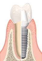 como-es-un-implante-dental.jpg